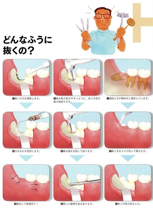 親知らず抜歯：コメント1