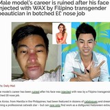 【海外発！Breaking News】鼻と顎の美容整形に大失敗　イケメンモデルのキャリアが台無しに（フィリピン）