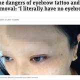 眉タトゥーに失敗し除去手術後、眉毛がなくなってしまった女性（豪）