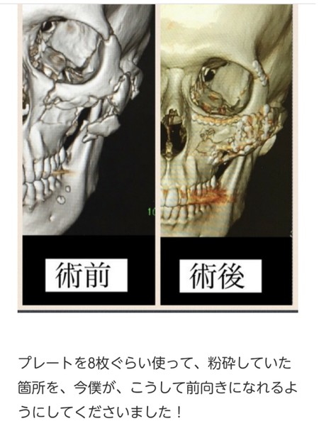 顔面殴られ重傷負った椿隆之、加害者の開き直った態度に本音「呆れるとしか言いようがない」：コメント11