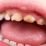 虫歯が10本以上で「口腔崩壊」に…　貧困家庭の子供たちの現実に人々唖然