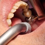 虫歯治療の古い常識　先進国で「銀歯」が主流なのは日本だけ