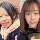 「整形への執着でなんとか生きていた」400万円の手術で女性が得られたものとは？